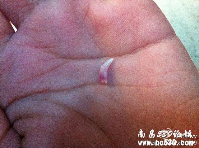 牙根断在牙龈里要紧吗