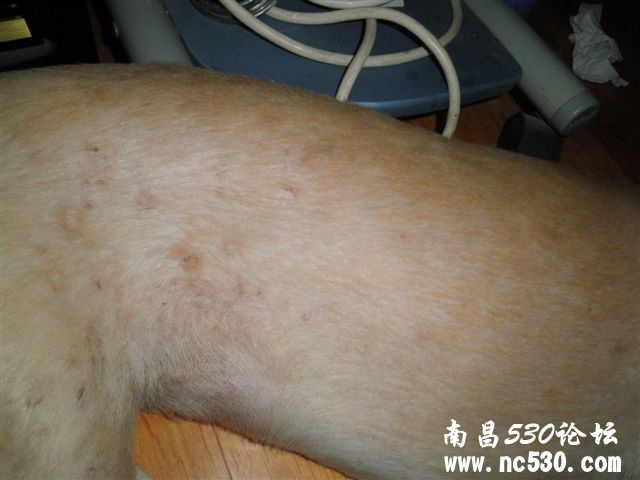 请帮忙看看这是不是皮肤病