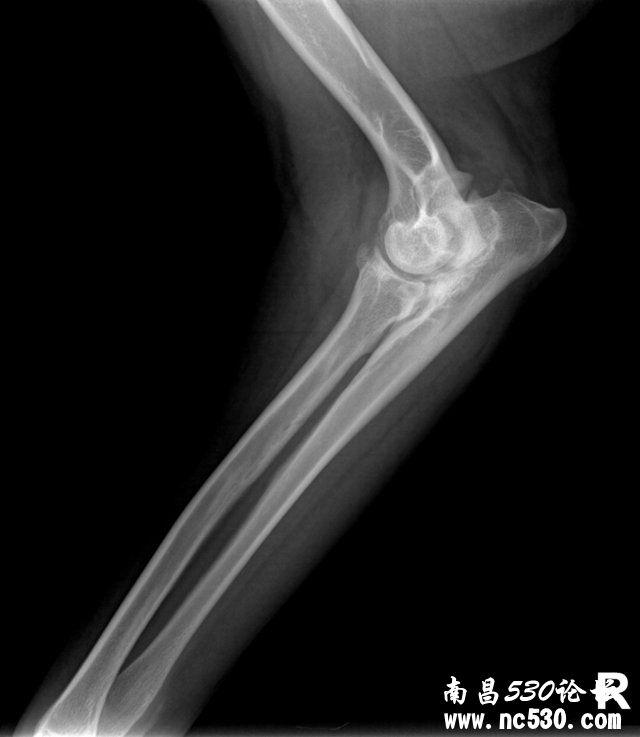 求帮我看下这张肘关节片子是否有问题及严重程度？